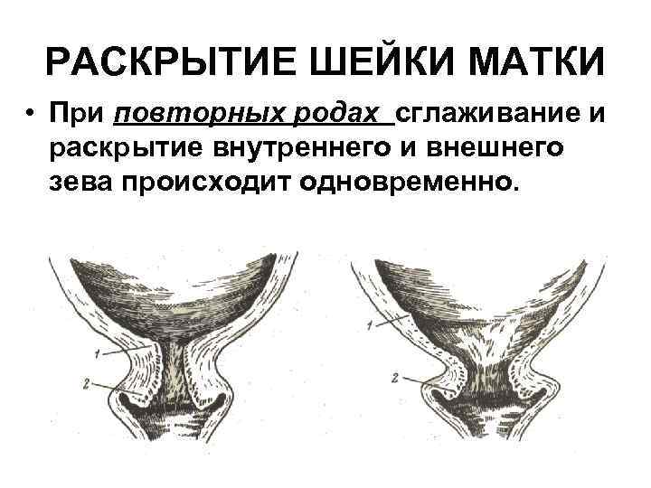 РАСКРЫТИЕ ШЕЙКИ МАТКИ • При повторных родах сглаживание и раскрытие внутреннего и внешнего зева