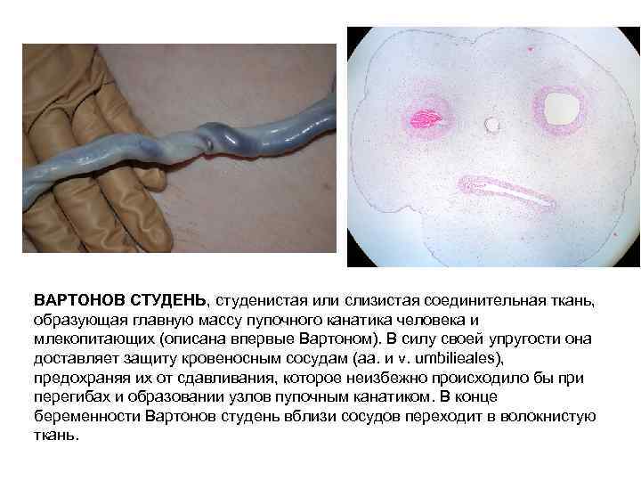 BAPTOHOB СТУДЕНЬ, студенистая или слизистая соединительная ткань, образующая главную массу пупочного канатика человека и