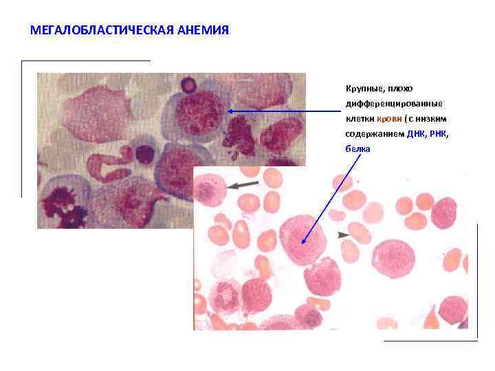МЕГАЛОБЛАСТИЧЕСКАЯ АНЕМИЯ Крупные, плохо дифференцированные клетки крови ( с низким содержанием ДНК, РНК, белка