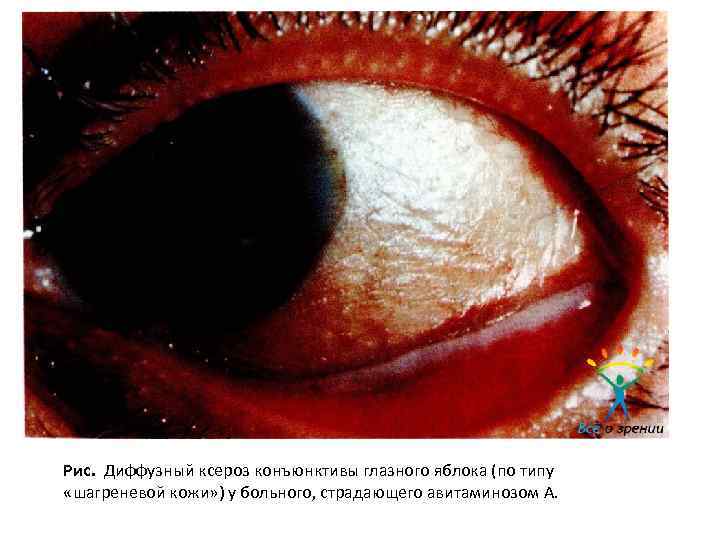 Рис. Диффузный ксероз конъюнктивы глазного яблока (по типу «шагреневой кожи» ) у больного, страдающего