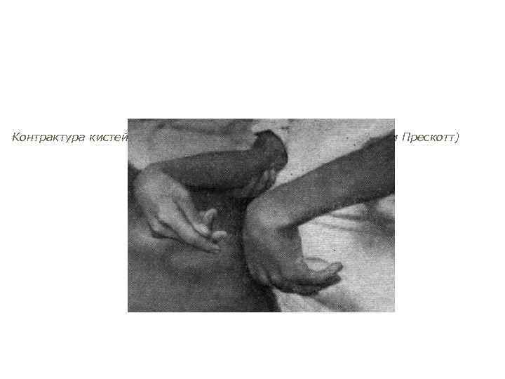 Контрактура кистей рук при бери-бери у человека (по Бикнелл и Прескотт) 
