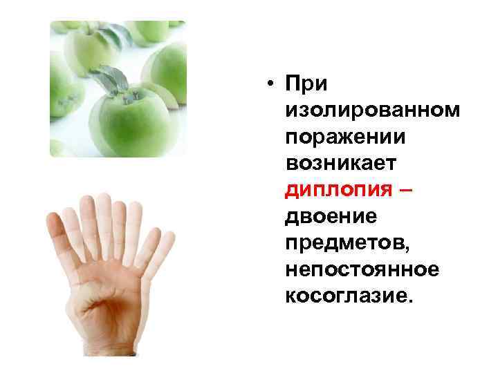  • При изолированном поражении возникает диплопия – двоение предметов, непостоянное косоглазие. 