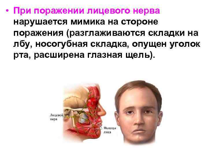  • При поражении лицевого нерва нарушается мимика на стороне поражения (разглаживаются складки на