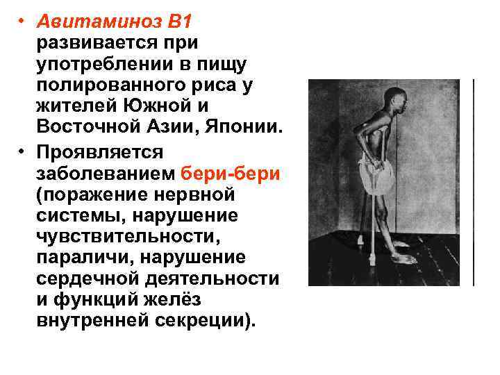  • Авитаминоз В 1 развивается при употреблении в пищу полированного риса у жителей