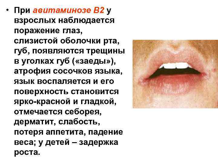  • При авитаминозе В 2 у взрослых наблюдается поражение глаз, слизистой оболочки рта,