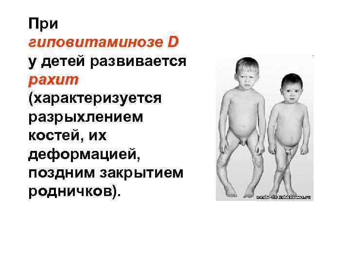 При гиповитаминозе D у детей развивается рахит (характеризуется разрыхлением костей, их деформацией, поздним закрытием