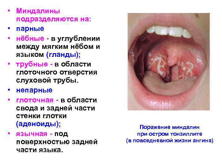  • Миндалины подразделяются на: • парные • нёбные - в углублении между мягким