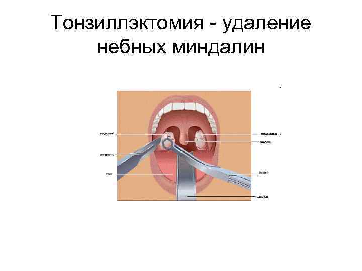 Тонзиллэктомия - удаление небных миндалин 