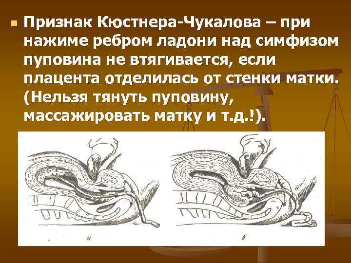 n Признак Кюстнера-Чукалова – при нажиме ребром ладони над симфизом пуповина не втягивается, если