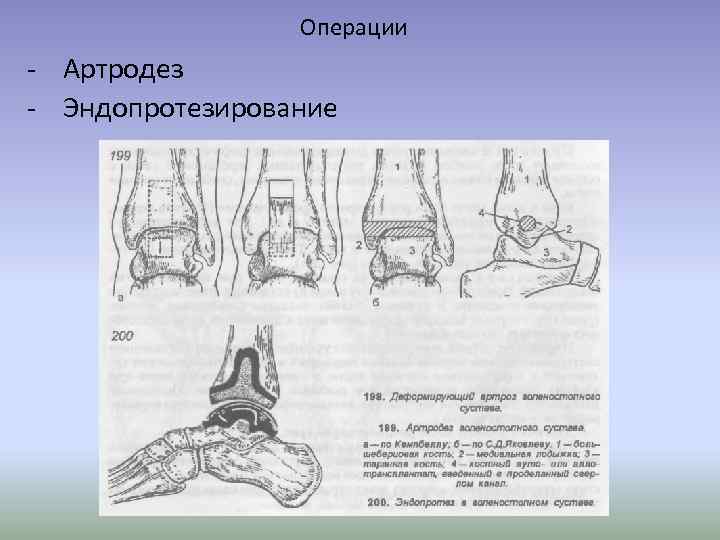 Операции - Артродез - Эндопротезирование 