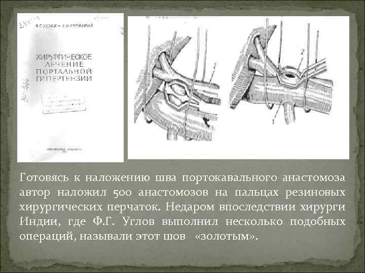 Готовясь к наложению шва портокавального анастомоза автор наложил 500 анастомозов на пальцах резиновых хирургических