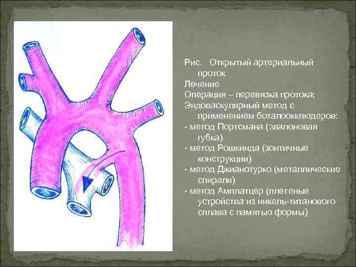 Рис. Открытый артериальный проток Лечение Операция – перевязка протока; Эндоваскулярный метод с применением боталоокклюдеров: