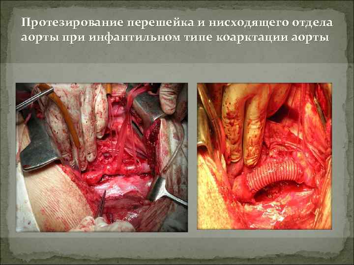 Протезирование перешейка и нисходящего отдела аорты при инфантильном типе коарктации аорты 