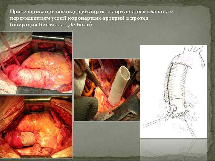 Протезирование восходящей аорты и аортального клапана с перемещением устий коронарных артерий в протез (операция