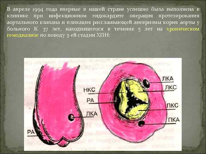 В апреле 1994 года впервые в нашей стране успешно была выполнена в клинике при