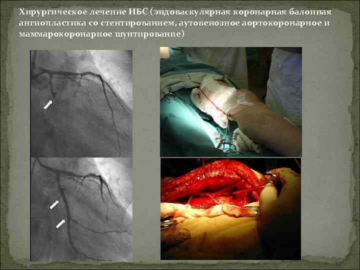 Хирургическое лечение ИБС (эндоваскулярная коронарная балонная ангиопластика со стентированием, аутовенозное аортокоронарное и маммарокоронарное шунтирование)