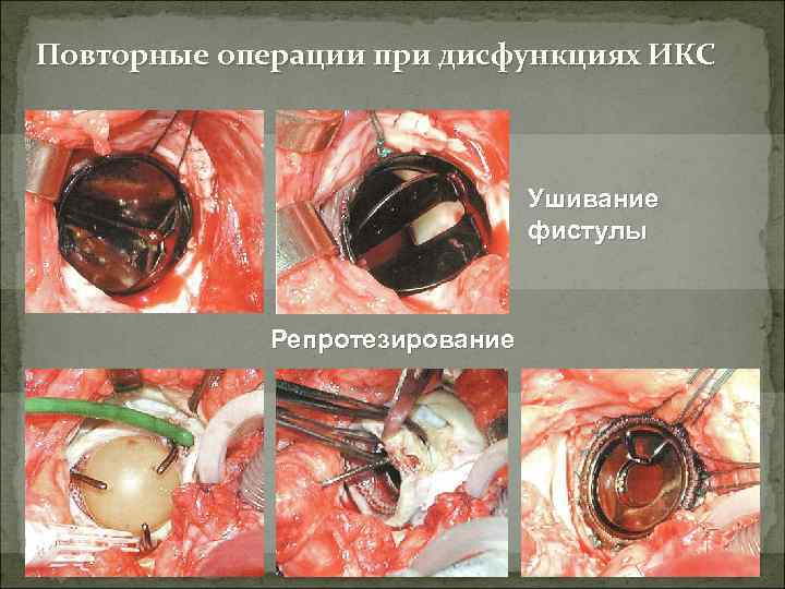 Повторные операции при дисфункциях ИКС Ушивание фистулы Репротезирование 
