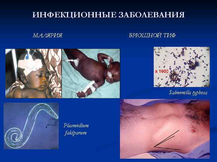 ИНФЕКЦИОННЫЕ ЗАБОЛЕВАНИЯ МАЛЯРИЯ БРЮШНОЙ ТИФ Salmonella typhosa Plasmodium falciparum 