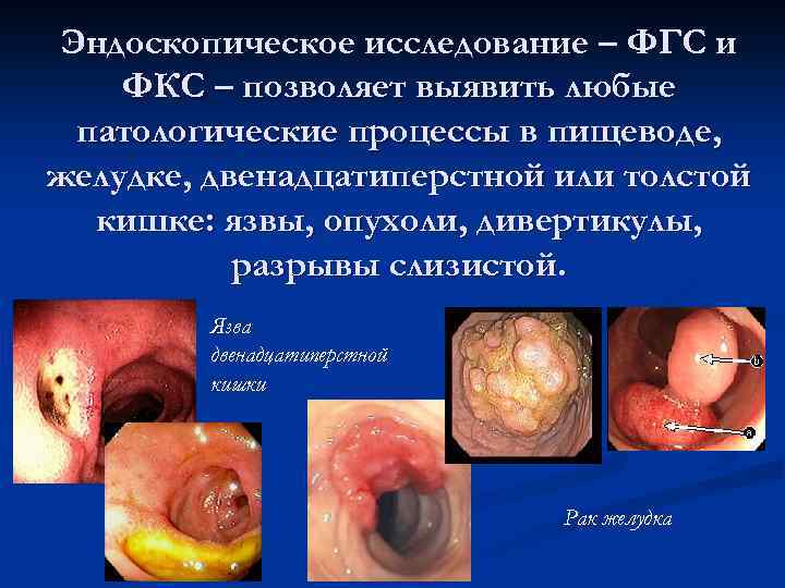 Эндоскопическое исследование – ФГС и ФКС – позволяет выявить любые патологические процессы в пищеводе,