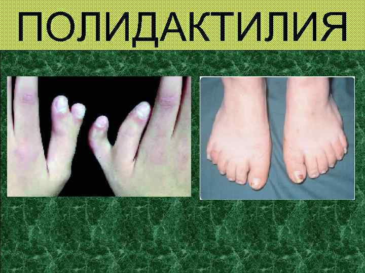 ПОЛИДАКТИЛИЯ 