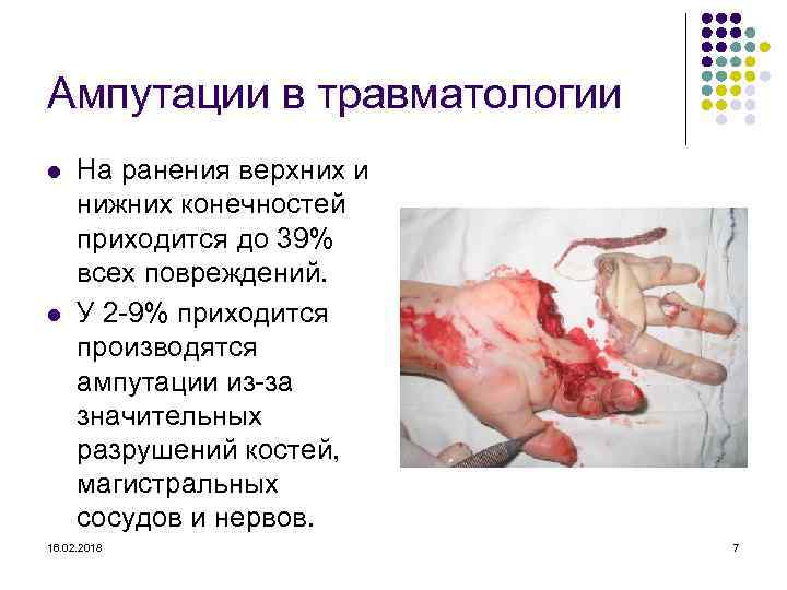 Ампутации в травматологии l l На ранения верхних и нижних конечностей приходится до 39%