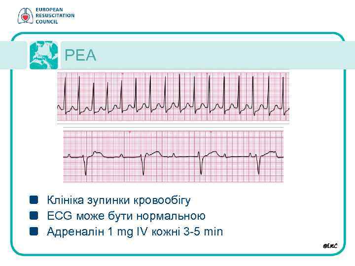 PEA Клініка зупинки кровообігу ECG може бути нормальною Aдреналін 1 mg IV кожні 3