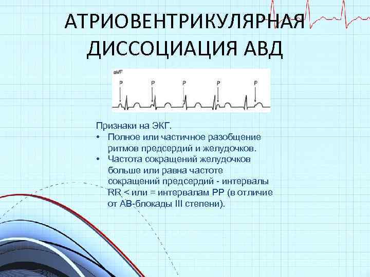 АТРИОВЕНТРИКУЛЯРНАЯ ДИССОЦИАЦИЯ АВД Признаки на ЭКГ. • Полное или частичное разобщение ритмов предсердий и