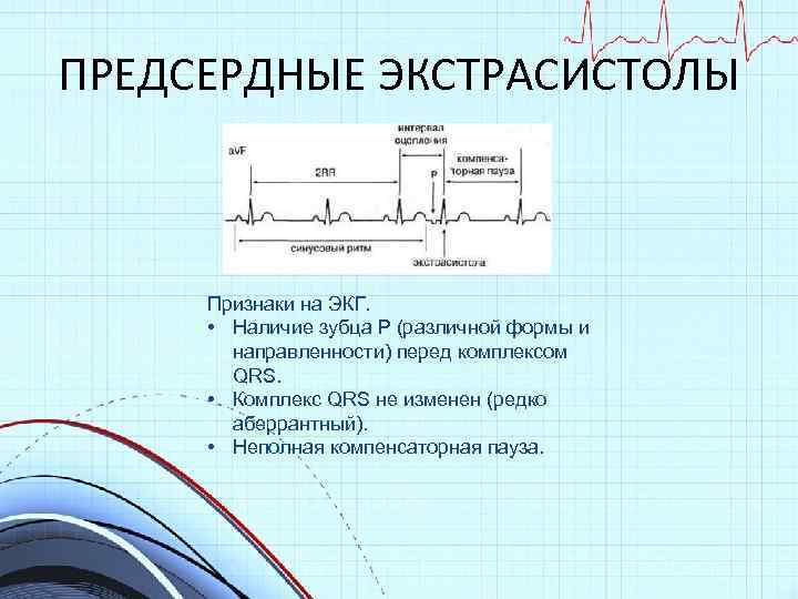 ПРЕДСЕРДНЫЕ ЭКСТРАСИСТОЛЫ Признаки на ЭКГ. • Наличие зубца Р (различной формы и направленности) перед