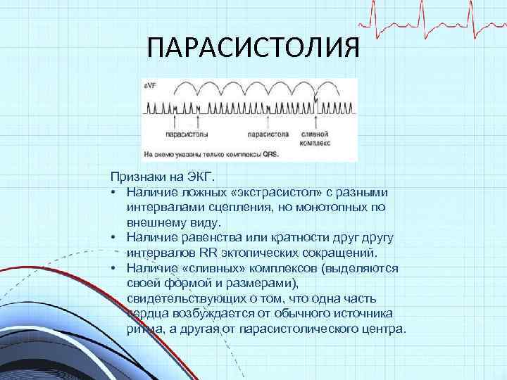 ПАРАСИСТОЛИЯ Признаки на ЭКГ. • Наличие ложных «экстрасистол» с разными интервалами сцепления, но монотопных