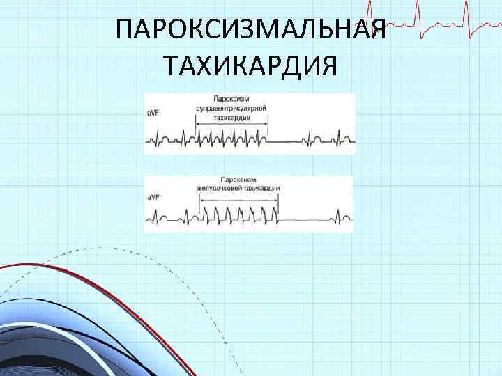 ПАРОКСИЗМАЛЬНАЯ ТАХИКАРДИЯ 