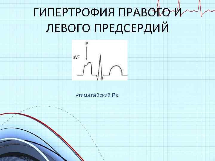 ГИПЕРТРОФИЯ ПРАВОГО И ЛЕВОГО ПРЕДСЕРДИЙ «гималайский Р» 