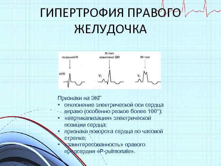 Отклонения на экг