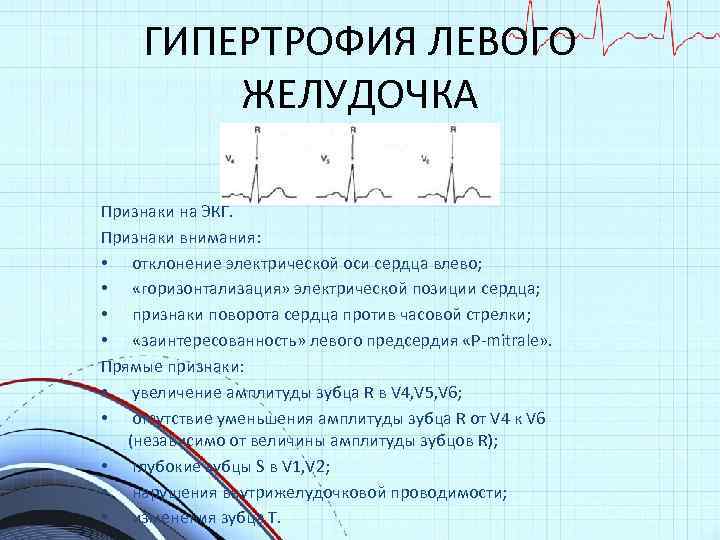 ГИПЕРТРОФИЯ ЛЕВОГО ЖЕЛУДОЧКА Признаки на ЭКГ. Признаки внимания: • отклонение электрической оси сердца влево;