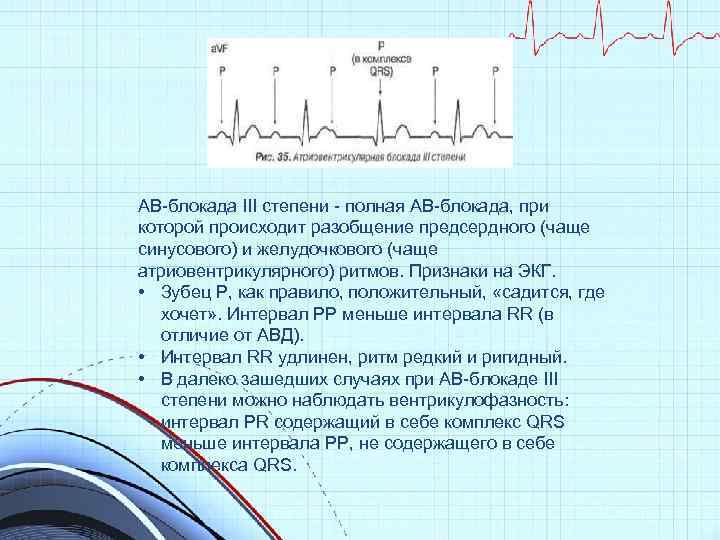 АВ-блокада III степени - полная АВ-блокада, при которой происходит разобщение предсердного (чаще синусового) и