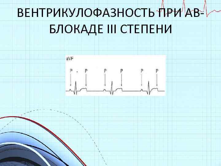 ВЕНТРИКУЛОФАЗНОСТЬ ПРИ АВБЛОКАДЕ III СТЕПЕНИ 