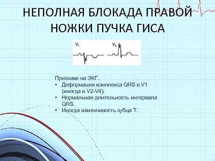 НЕПОЛНАЯ БЛОКАДА ПРАВОЙ НОЖКИ ПУЧКА ГИСА Признаки на ЭКГ. • Деформация комплекса QRS в