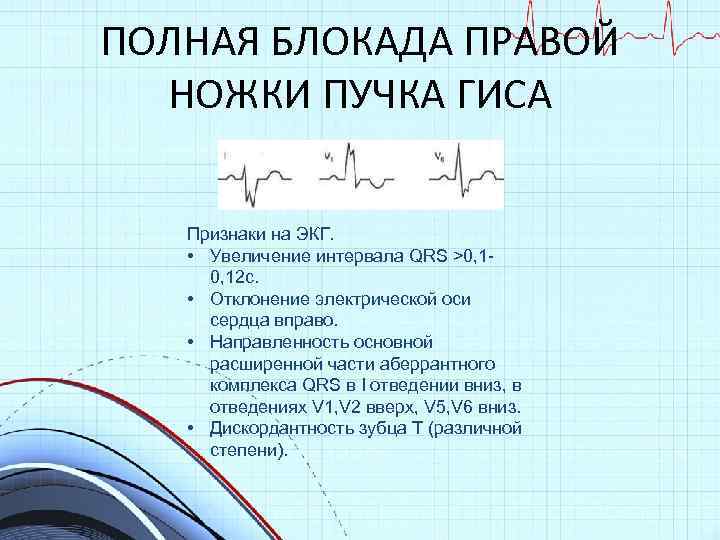 Блокада пнпг. Признаки полной блокады правой ножки пучка Гиса. БПНПГ ЭКГ признаки. Признаки блокады ПНПГ. Блокада ПНПГ ЭКГ признаки.