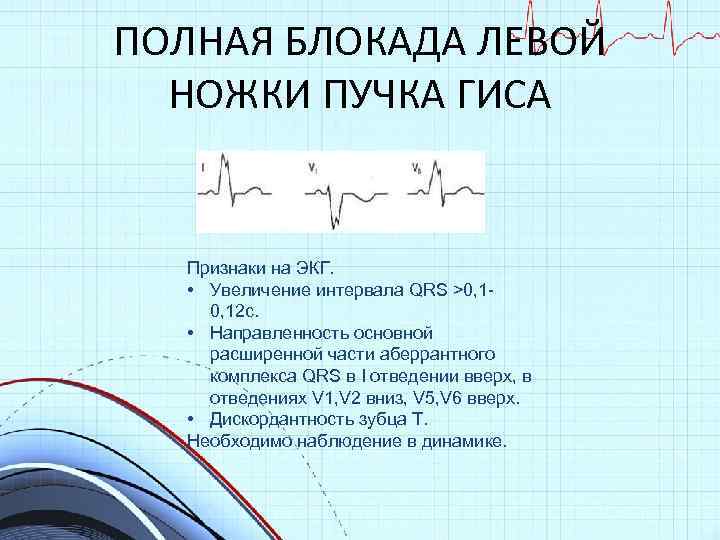 ПОЛНАЯ БЛОКАДА ЛЕВОЙ НОЖКИ ПУЧКА ГИСА Признаки на ЭКГ. • Увеличение интервала QRS >0,