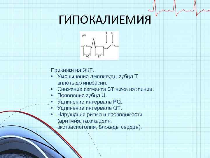 Гипокалиемия на экг картинки