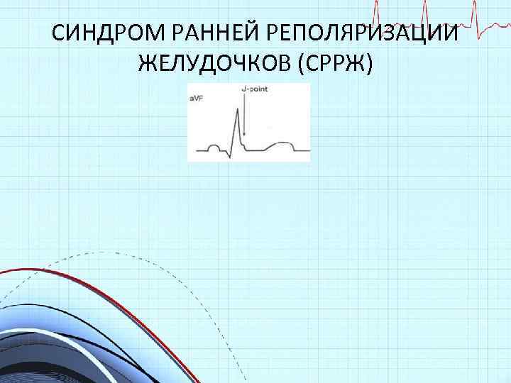 Синдром ранней реполяризации желудочков