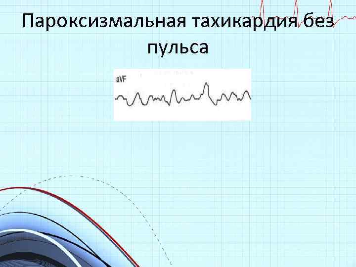 Пароксизмальная тахикардия без пульса 