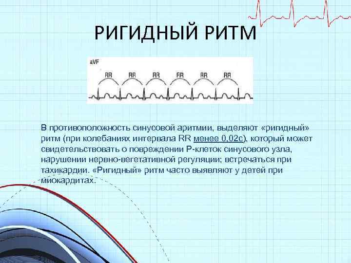 РИГИДНЫЙ РИТМ В противоположность синусовой аритмии, выделяют «ригидный» ритм (при колебаниях интервала RR менее