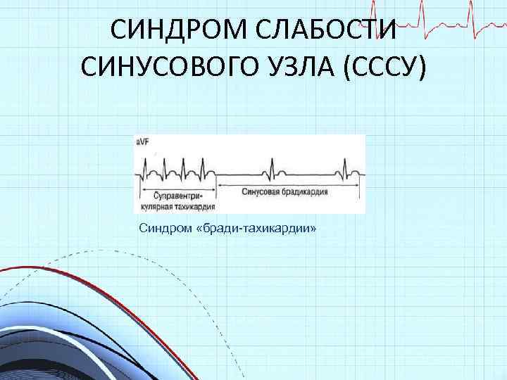 Синдром слабости синусового узла карта вызова смп