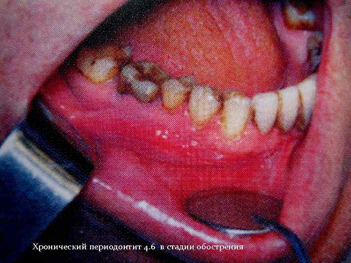 Хронический периодонтит 4. 6 в стадии обострения 