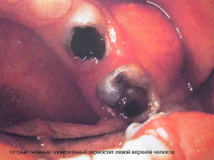 Острый гнойный одонтогенный периостит левой верхней челюсти 