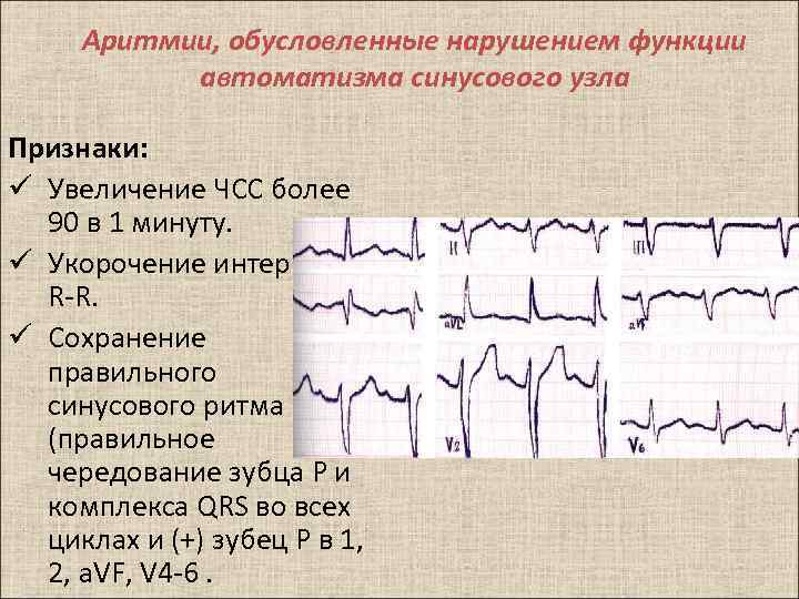 Нарушение синусового. Критерии синусового ритма на ЭКГ. Признаки синусового ритма на ЭКГ. Признаки нормального синусового ритма. ЭКГ при нарушениях функции АВТОМАТИЗМА синусового узла.