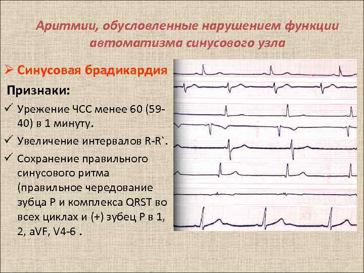 Аритмии, обусловленные нарушением функции автоматизма синусового узла Ø Синусовая брадикардия Признаки: ü Урежение ЧСС