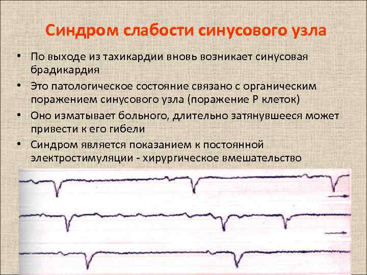 Синусовая тахикардия карта смп