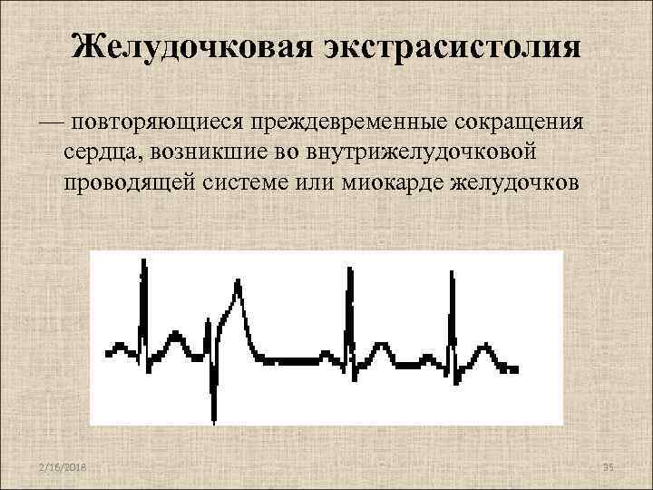 Экстрасистолы во время. Экстрасистолия нарушение проводимости. Желудочковая экстрасистолия аускультация. Желудочковая экстрасистолия на ЭКГ ЧСС. Синусовый ритм при желудочковой экстрасистолии.