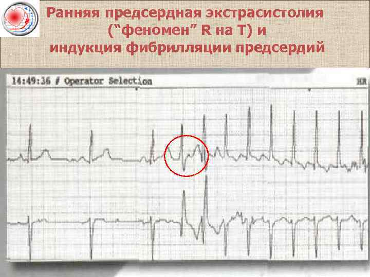 Ранняя предсердная экстрасистолия (“феномен” R на Т) и индукция фибрилляции предсердий 